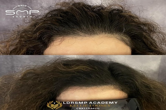 Reclaim Confidence with Scalp Micropigmentation