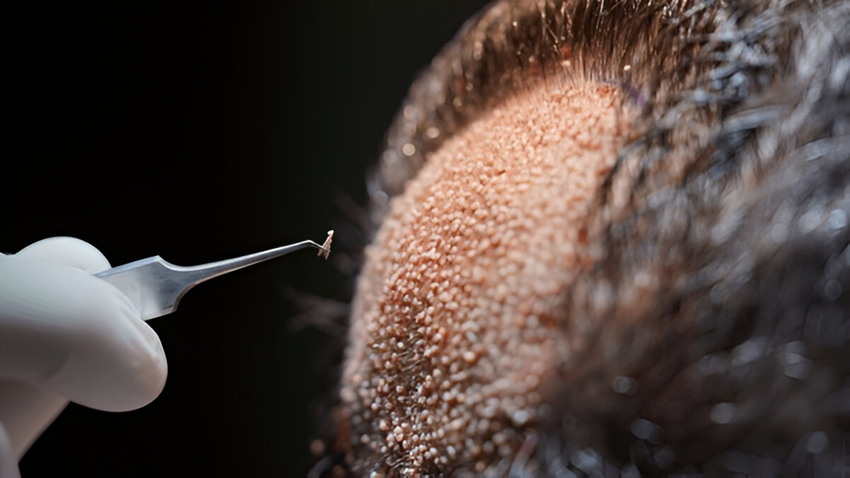 Hair Transplant