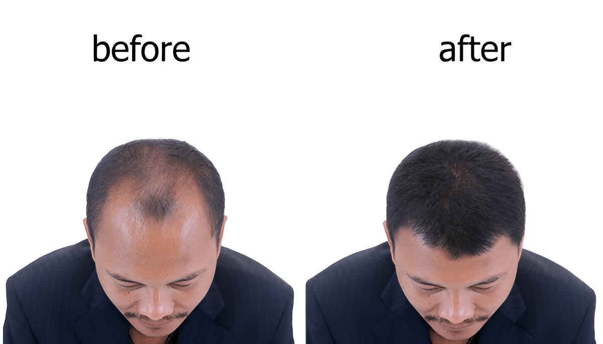 best hair transplant London