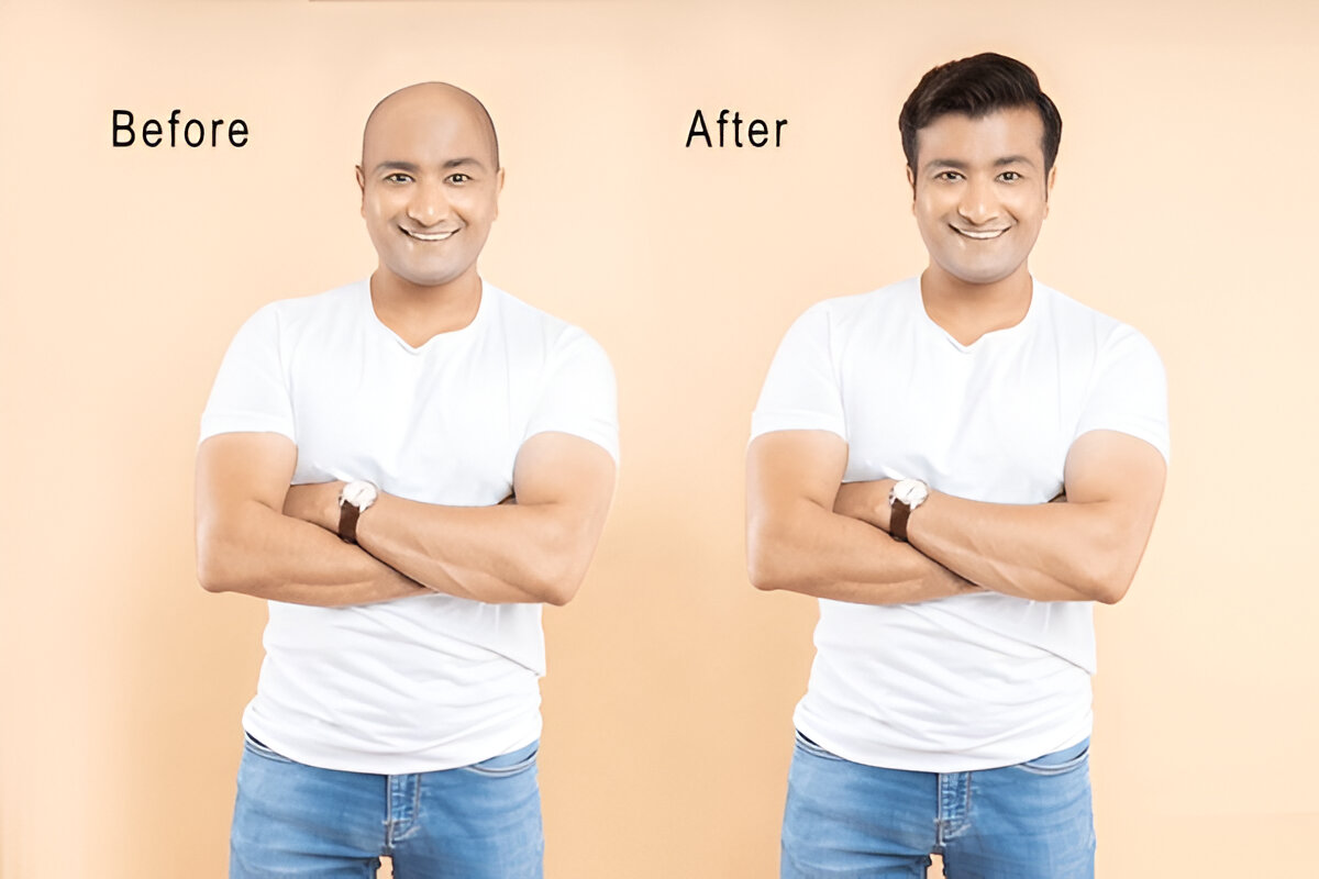 What Happens If Your Hair Transplant Fails?