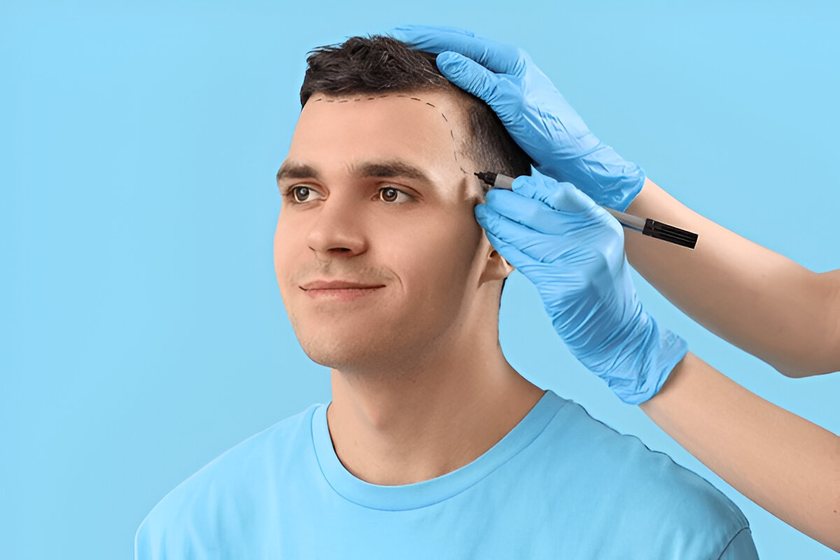 Does Health Insurance Cover Hair Transplants in the UK