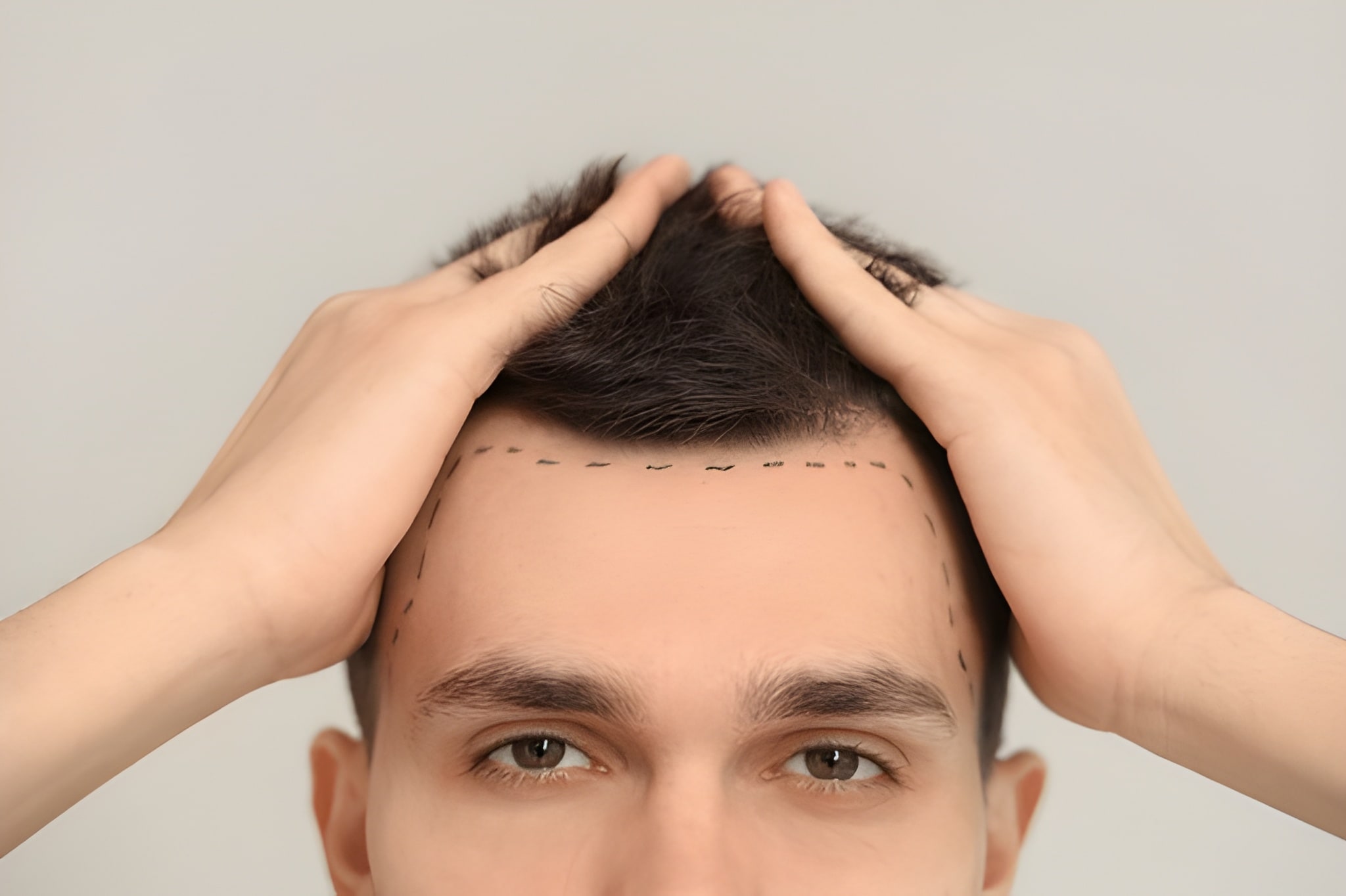 Can You Get a Hair Transplant If You Have Alopecia?