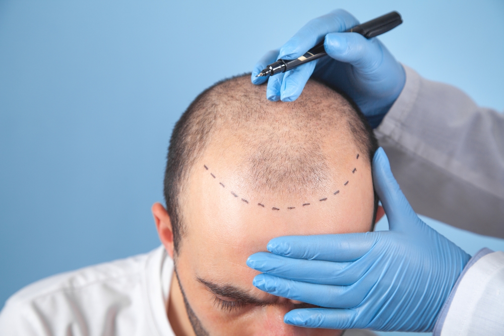 Hair Transplant Scams: How to Avoid Them in the UK